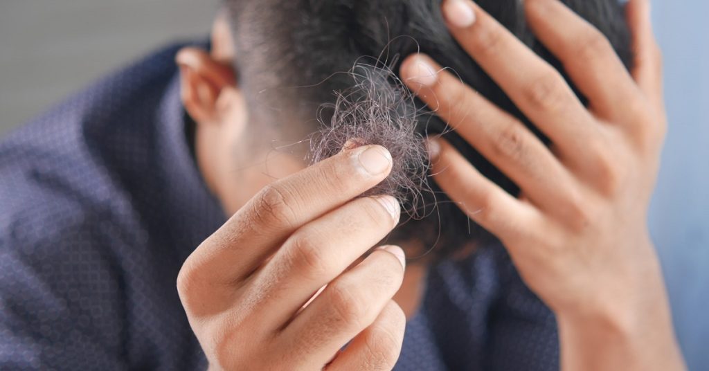 Erectile dysfunction and hair loss Edinburgh