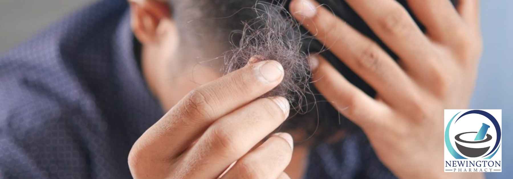 Erectile dysfunction and hair loss Edinburgh