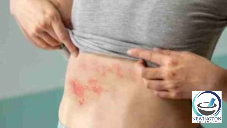 shingles treatment edinburgh