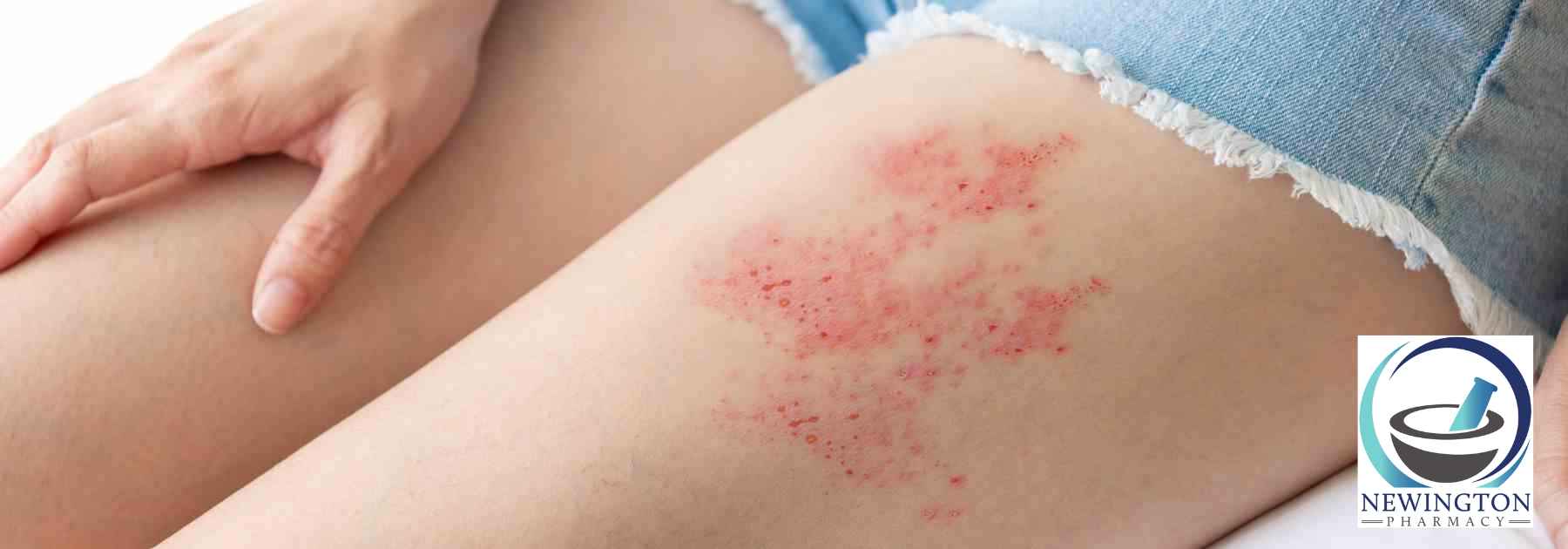 shingles treatment edinburgh