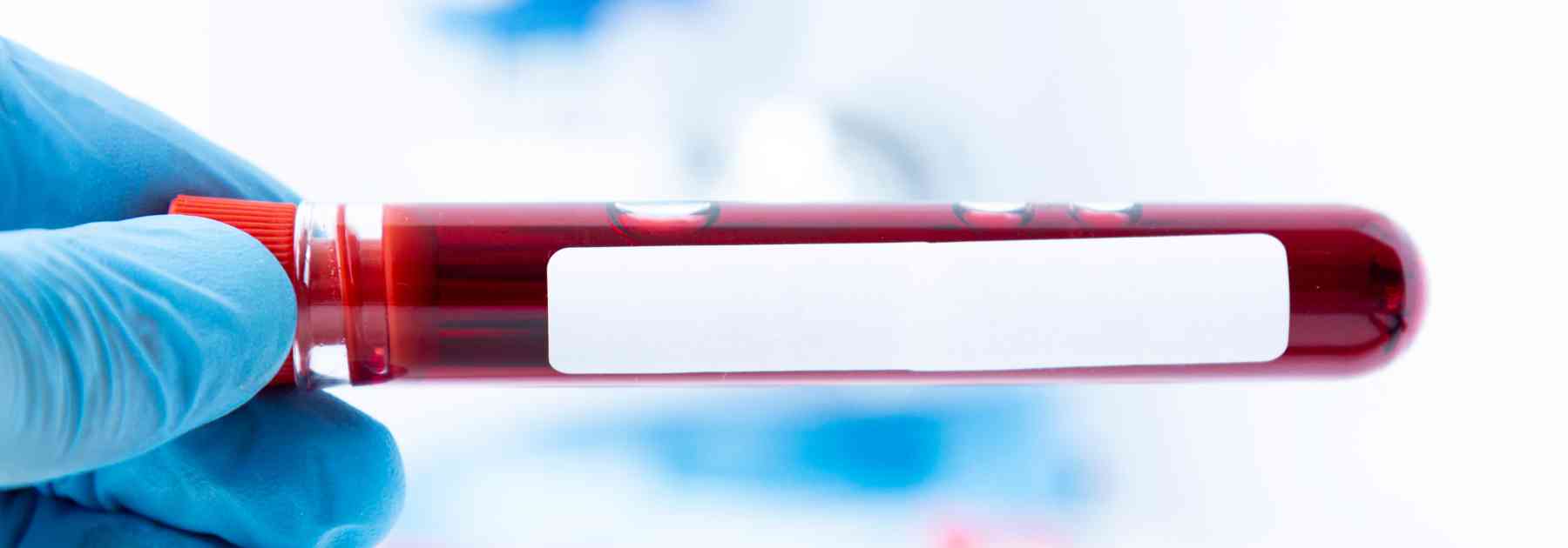 private ferritin blood test edinburgh