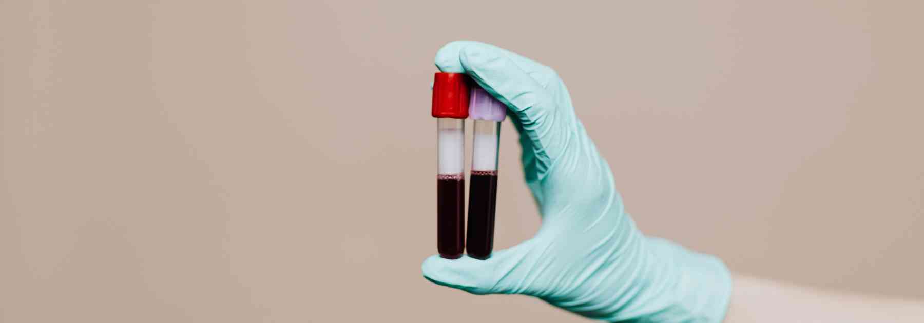 person wearing medical glove holding two blood tests