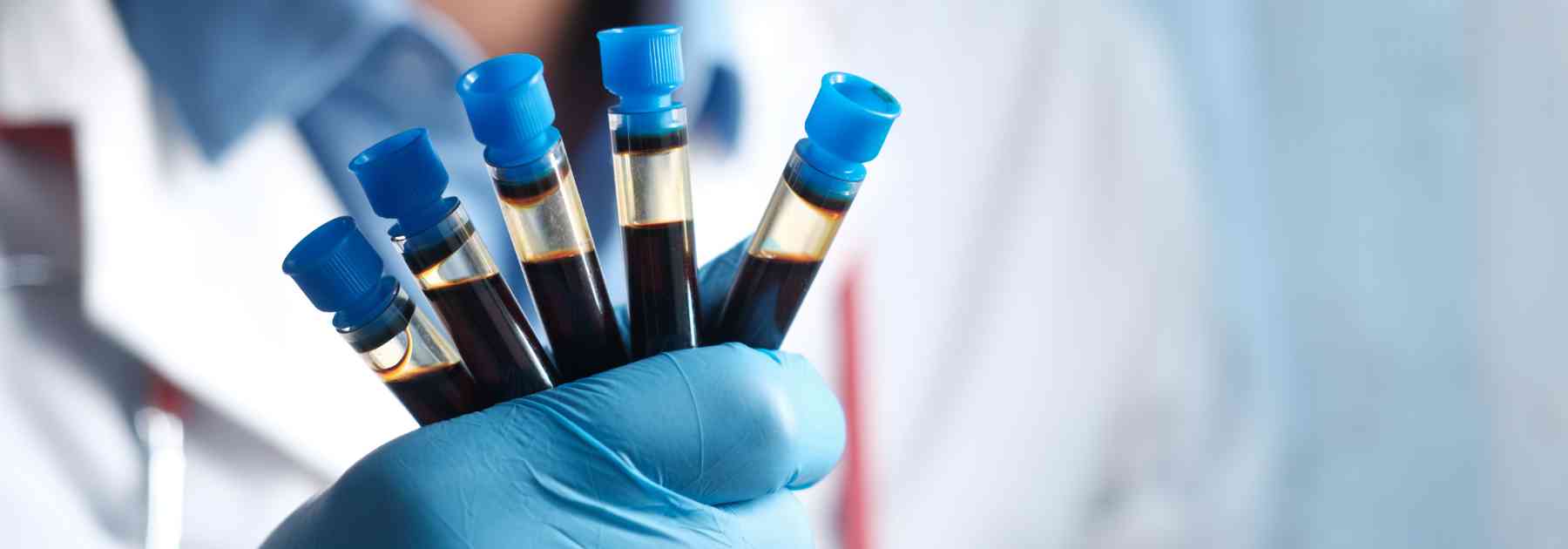 person wearing medical glove holding blood tests