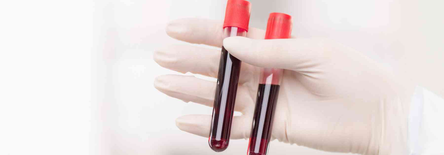 person wearing medical glove holding two blood tests