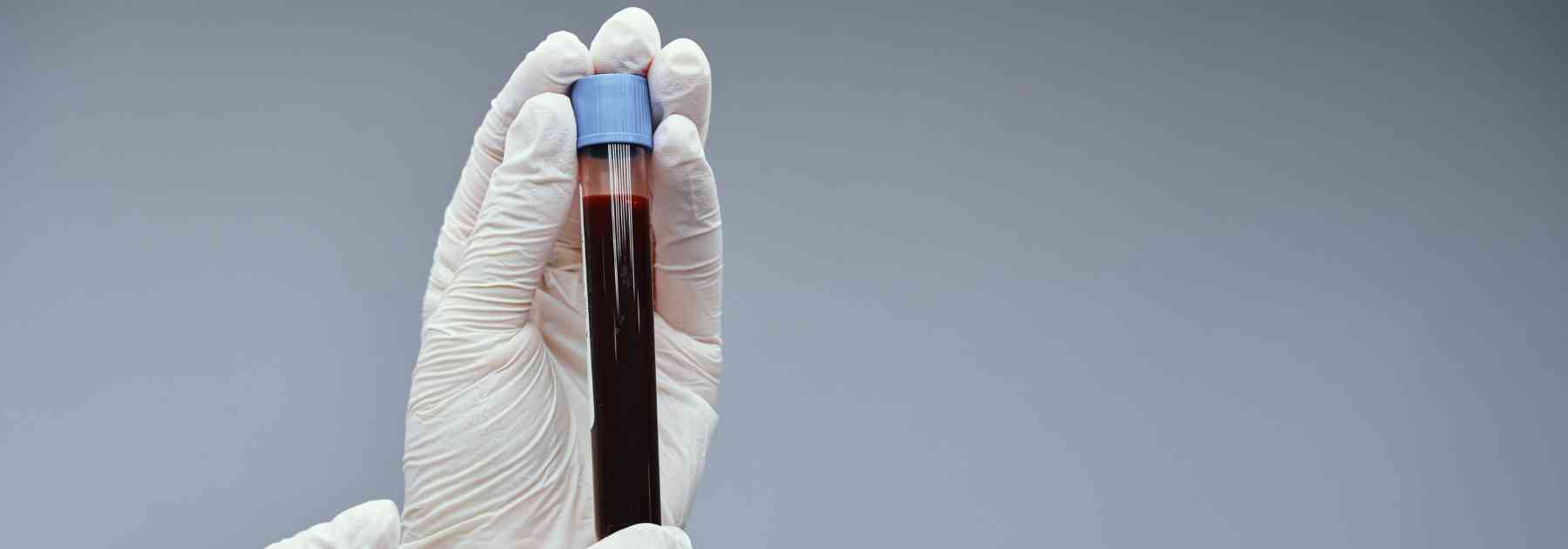 person wearing medical glove holding blood test