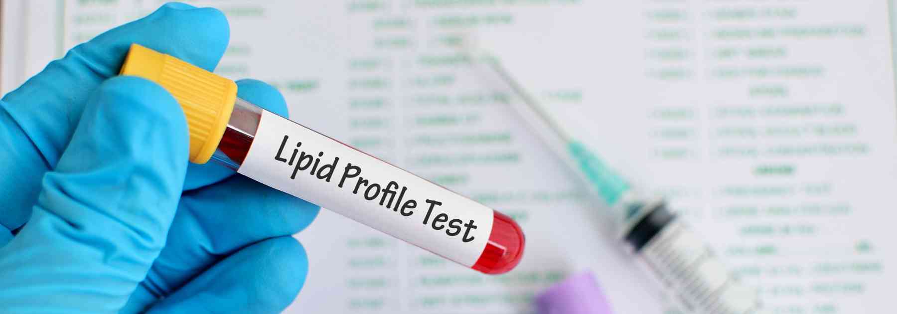 person wearing medical glove holding lipid profile blood test