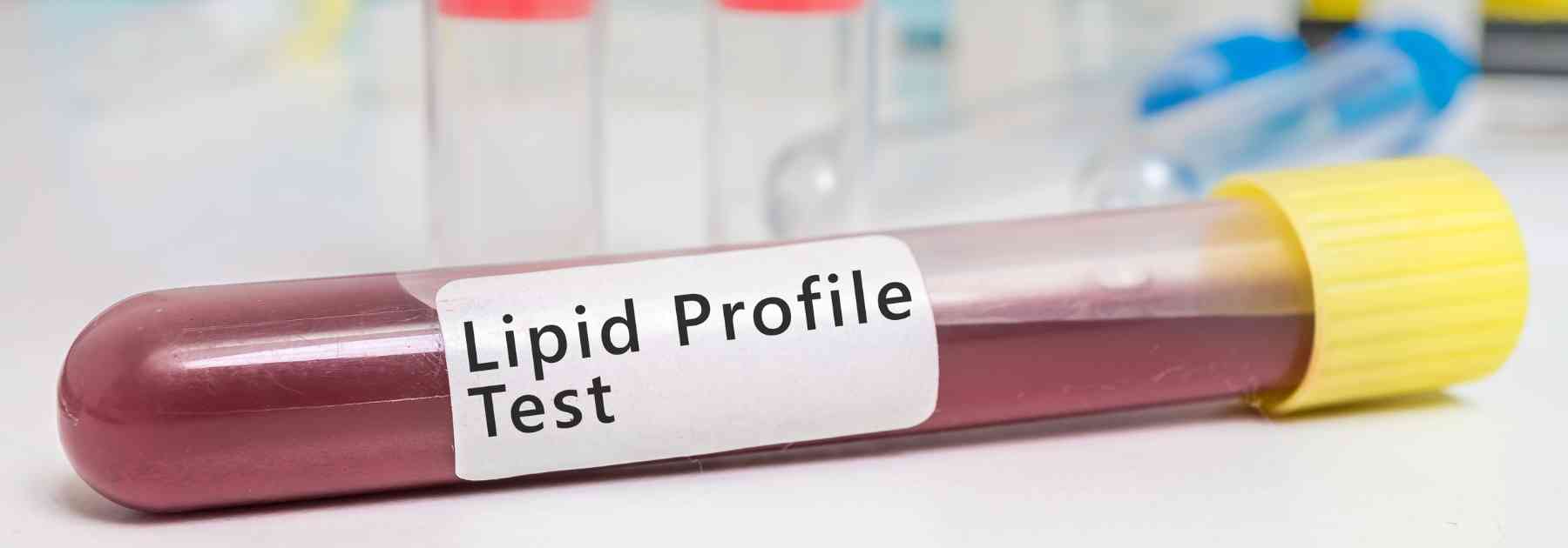 blood test labelled lipid profile test
