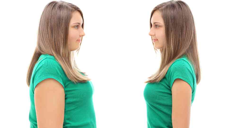 before and after pictures of female weight loss patient